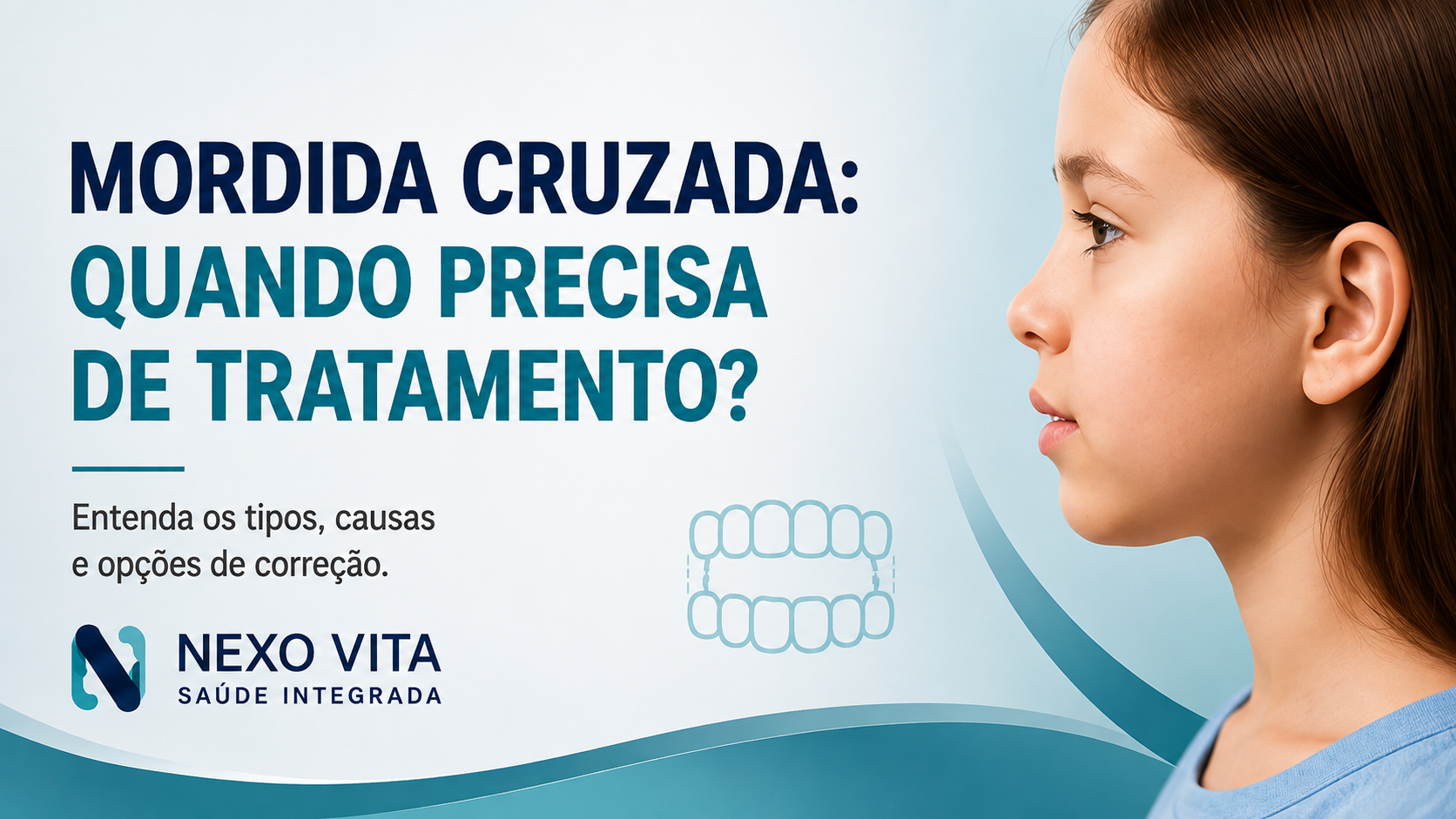 Ilustração odontológica demonstrando relação de mordida cruzada