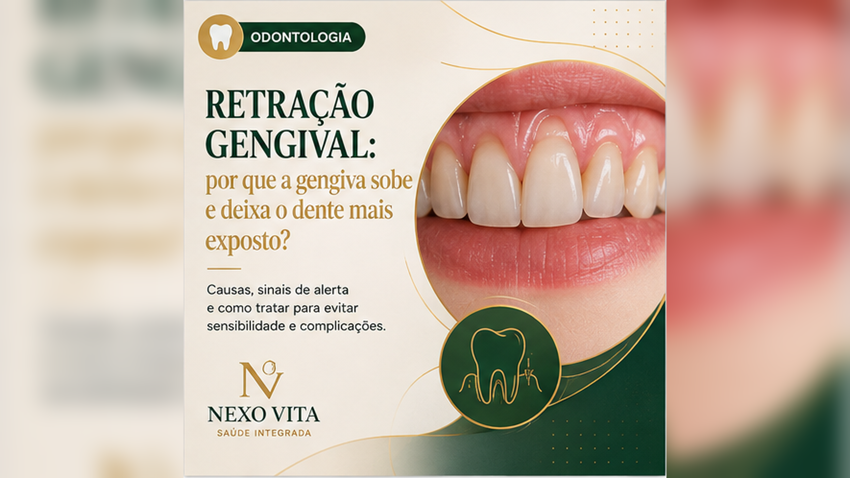 Ilustração odontológica mostrando retração gengival e exposição da raiz do dente