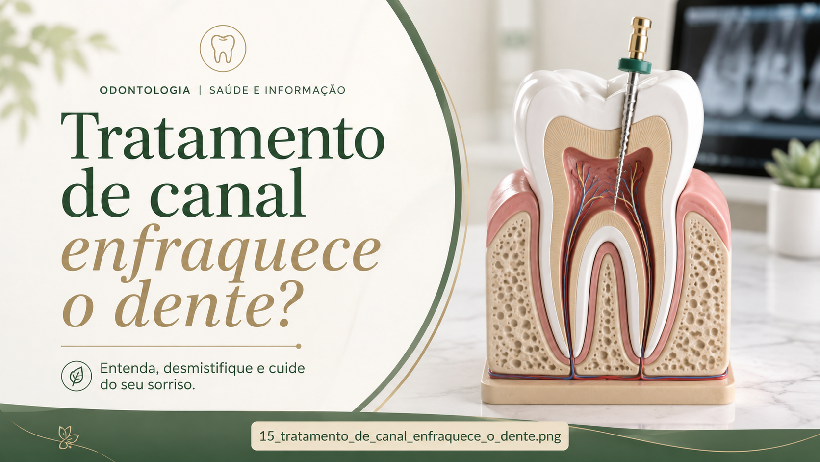 Modelo de dente demonstrando a região tratada no canal